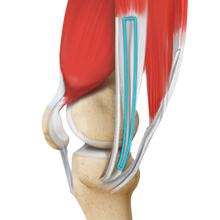 ACL Reconstruction Hamstring Tendon