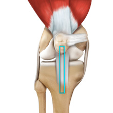 ACL Reconstruction Patellar Tendon