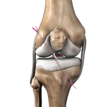 Anterior Cruciate Ligament ACL Reconstruction