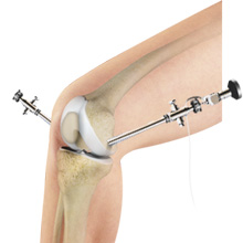 Arthroscopy of the Knee Joint