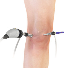 Arthroscopy of the Knee Joint