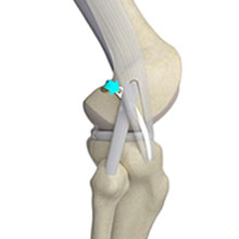 Lateral Extraarticular Procedures (LEAPs)
									