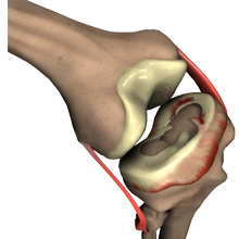 Meniscus Tear