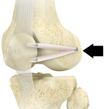 Medial Patellofemoral Ligament Reconstruction