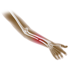 Pediatric Fractures