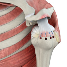 Rotator Cuff Repair