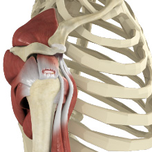 Rotator Cuff Tear