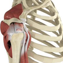 Rotator Cuff Tear