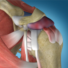 Shoulder Impingement