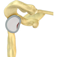 Shoulder Labral Repair