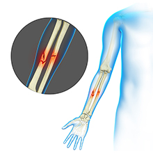 Upper and Lower Extremity Fractures